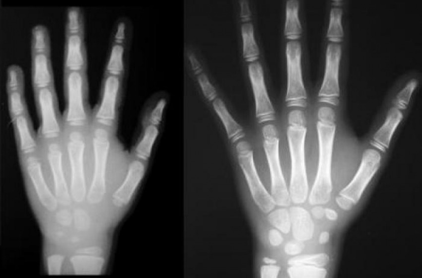 Finto minorenne smascherato con la radiografia del polso