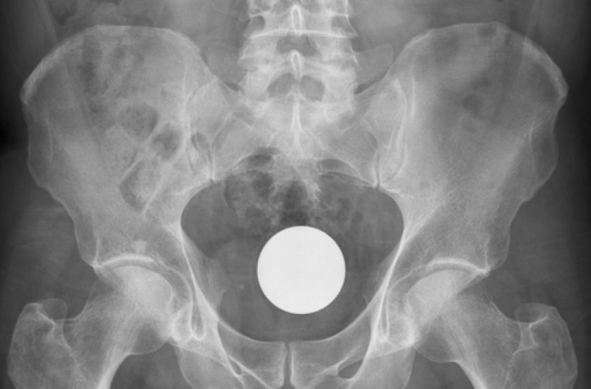 Ingoiano oltre 1 chilo di hashish da spacciare. Al Mazzini scattano le manette