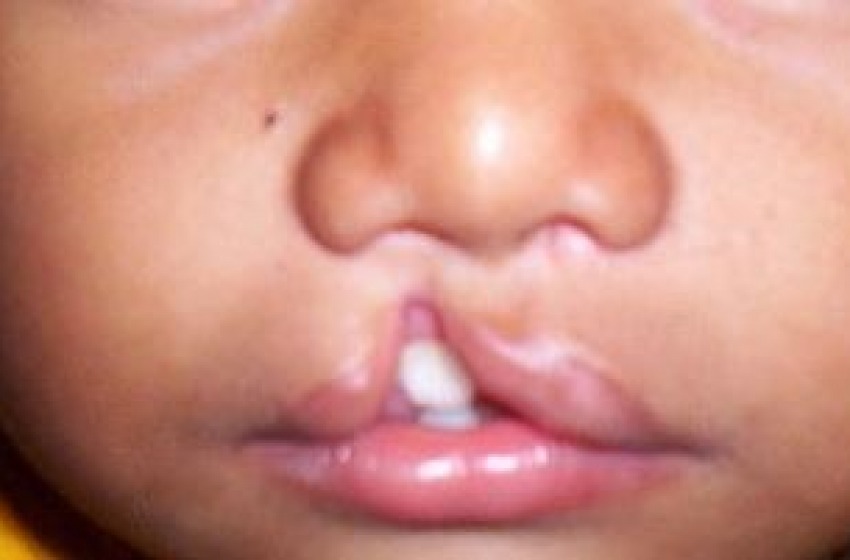 Labbro leporino: le cause genetiche